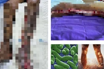 Người đàn ông 64 tuổi nguy kịch do nhiễm "vi khuẩn ăn thịt người"