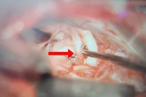 Điều trị thành công cho bệnh nhân mắc chứng co giật nửa mặt