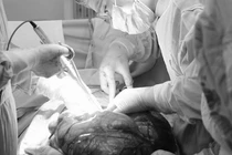 Tưởng bụng to do tăng cân, nam thanh niên không ngờ có khối u 8kg