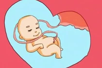 Nguyên nhân gây dây rốn quấn cổ thai nhi 