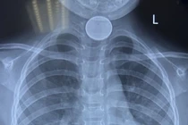 Bé 4 tuổi bị dị vật đồng xu nằm giữa thực quản