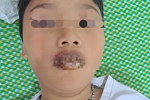 Tự dùng thuốc ho, sốt tại nhà trẻ 11 tuổi lở loét niêm mạc nặng