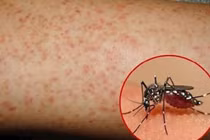 Hà Nội đang có bao nhiêu ca mắc sốt xuất huyết?