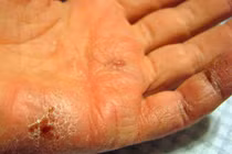 Da nứt nẻ vì hanh khô, bác sĩ bày cách xử lý
