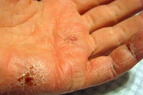 Da nứt nẻ vì hanh khô, bác sĩ bày cách xử lý