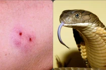 Bác sĩ mách cách xử lý rắn cắn tránh hoại tử, nhiễm trùng huyết