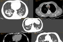 Sút cân, ho kéo dài... nào ngờ mắc phổi không lao NTM