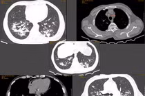 Sút cân, ho kéo dài... nào ngờ mắc phổi không lao NTM