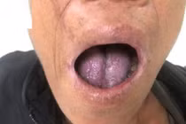 Tái sinh lưỡi của bệnh nhân sau cắt bỏ ung thư