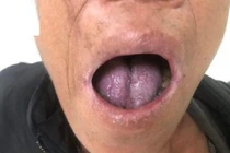 Tái sinh lưỡi của bệnh nhân sau cắt bỏ ung thư