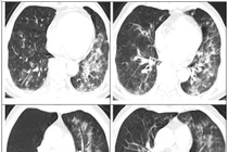 Nhiều người tự chữa cúm A khiến phổi đông đặc, suy hô hấp phải nhập viện 