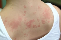 Cô gái mắc hội chứng dị ứng hiếm gặp với... mọi thứ