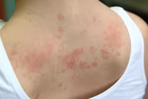 Cô gái mắc hội chứng dị ứng hiếm gặp với... mọi thứ