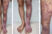 Chân sùi biến dạng do nhiễm nấm nhiệt đới