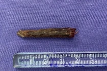  Đũa gỗ đâm trong cổ bé trai 5 tuổi được lấy ra