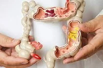 Polyp đại trực tràng ác tính