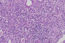 Tăng axit uric gây viêm ống thận kẽ ở người trẻ