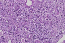 Tăng axit uric gây viêm ống thận kẽ ở người trẻ