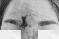 Tiêm filler nâng mũi, quý ông 36 tuổi phải cấp cứu vì hoại tử