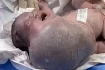 Phẫu thuật khối u vùng mặt, cổ, ngực lớn nhất y văn thế giới