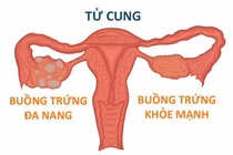 buồng trứng đa nang