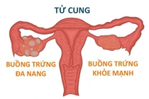 buồng trứng đa nang