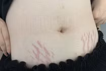 Chăm nhỏ thuốc mũi: Cô gái 23 tuổi bị lùn và lão hóa sớm