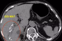 Tán sỏi mật qua da giúp bảo tồn mật