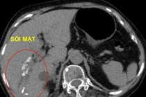 Tán sỏi mật qua da giúp bảo tồn mật