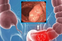 Đối tượng dễ mắc ung thư đại trực tràng, cần phát hiện sớm