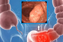 Đối tượng dễ mắc ung thư đại trực tràng, cần phát hiện sớm