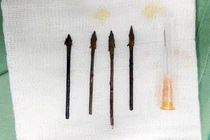 3 chuyên khoa hợp sức cứu trẻ bị 4 mũi tên đâm giữa mặt