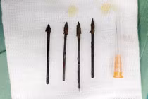 3 chuyên khoa hợp sức cứu trẻ bị 4 mũi tên đâm giữa mặt