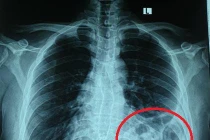 Bóng khí của đại tràng ở trên ngực trái trên X - quang