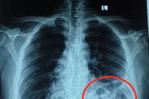 Bóng khí của đại tràng ở trên ngực trái trên X - quang
