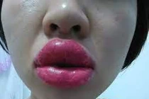 Biến chứng khi xăm môi