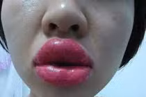 Biến chứng khi xăm môi