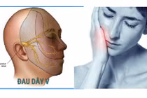 Nối dây thần kinh chữa liệt mặt