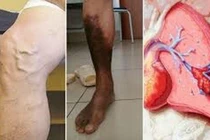 Đau liên tục cẳng bàn chân, người bệnh phải can thiệp động mạch chi