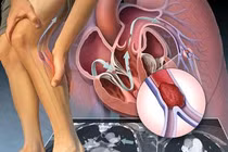 Địa chỉ vàng: Các bệnh viện tuyến đầu điều trị tắc động mạch chi