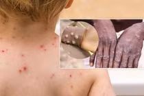 Chỉ đạo tăng cường phòng, chống đậu mùa khỉ tại Đắk Lắk