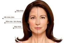 Bác sĩ chỉ cách khắc phục da đồi mồi, nếp nhăn … ở phụ nữ mãn kinh