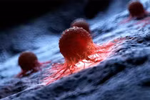 14 loại ung thư ở người dưới 50 tuổi tăng đột biến