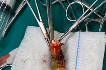 Phối hợp liên khoa cứu bệnh nhân gẫy canuyn rơi vào đường thở