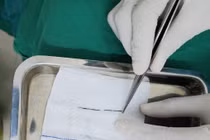 Đi chữa gãy xương phát hiện kim may áo quần trong nhu mô phổi