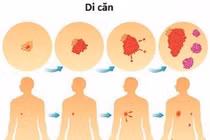 Fucoidan điều trị ung thư?