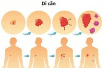 Fucoidan điều trị ung thư?