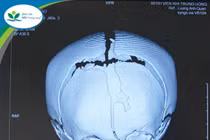 Lần đầu tiên: Trẻ 17 tháng tuổi mổ khe hở sọ mặt phức tạp, hiếm gặp