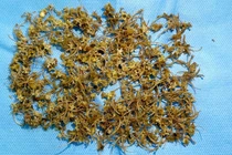 Nam bệnh nhân bị tắc ruột do nuốt hàng ngàn mảnh xương rắn