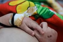 Bé 2 tuổi ở Cao Bằng tử vong nghi do mắc sởi